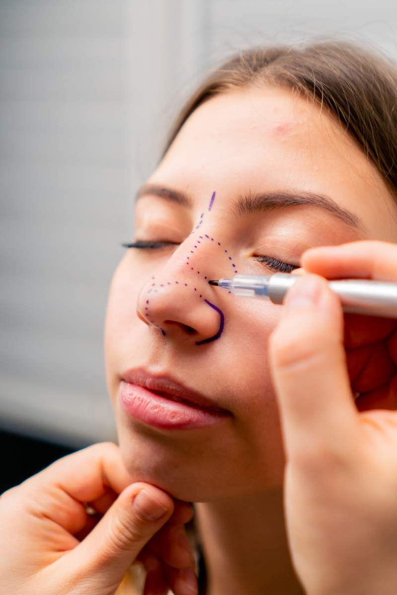 close-up plastic surgeon makes marks on a patient's face during a consultation before nose operation