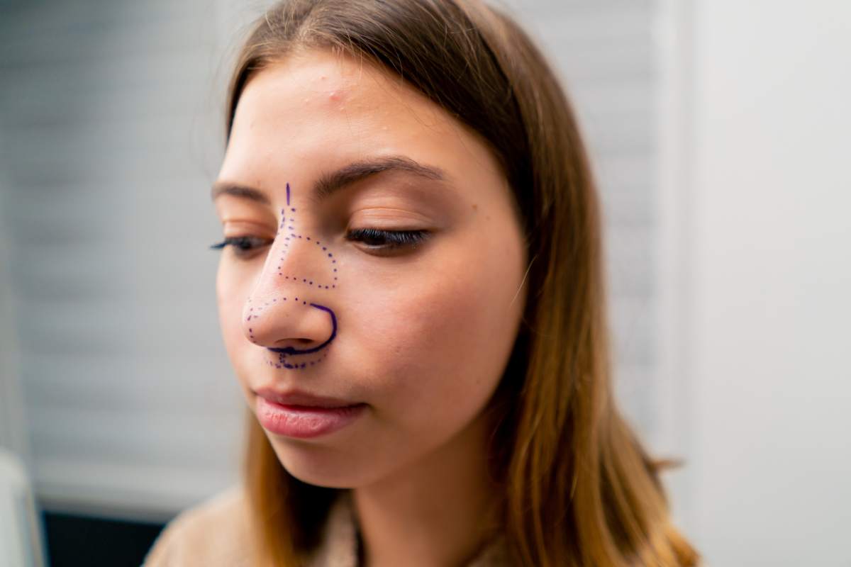 close-up plastic surgeon makes marks on a patient's face during a consultation before nose operation