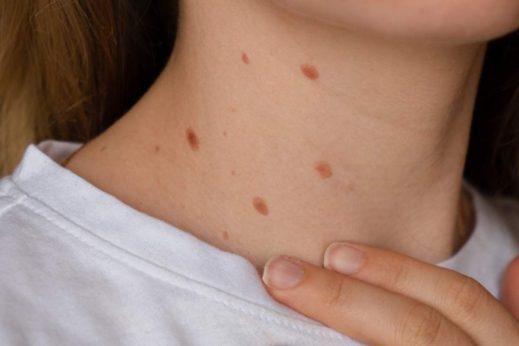 Unrecognizable woman showing her Birthmarks on neck skin Close up detail of the bare skin Sun Exposure effect on skin, Health Effects of UV Radiation Woman with birthmarks Pigmentation and lot of birthmarks