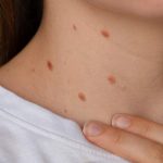 Unrecognizable woman showing her Birthmarks on neck skin Close up detail of the bare skin Sun Exposure effect on skin, Health Effects of UV Radiation Woman with birthmarks Pigmentation and lot of birthmarks